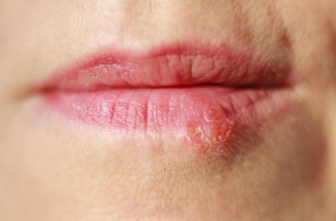 På tungen forkølelsessår Forkølelsessår (Herpes
